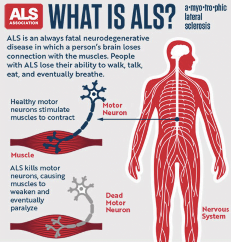 als-amyotrophic-lateral-sclerosis-version-1-0-frequency-research